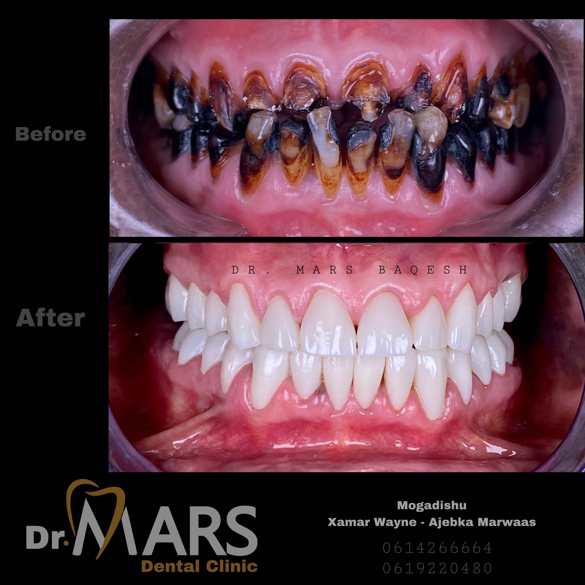 Composite Veneers